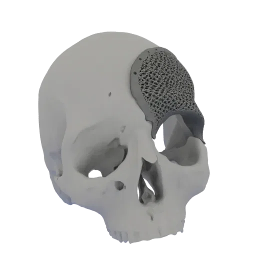 3D модель человеческого черепа с кастомным черепным имплантом решетчатой структуры, установленным в области височной кости.