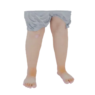 3D модель человеческих ног с кожным заболеванием на колене и красными пятнами на голенях.